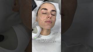 Amber Davies EndyMed Facial Tightening amp AgeJet Second Session at Dr MediSpa [upl. by Crist644]