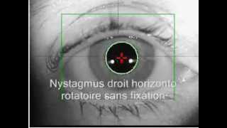 Nystagmus horizontal et rotatoire sans et après fixation [upl. by Enra]