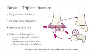 What is Triplane fracture [upl. by Edobalo]