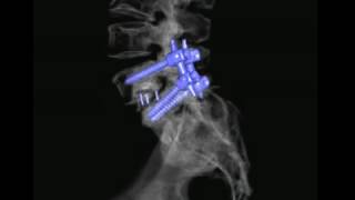 L 5S1 Posterolateral and interbody fusion [upl. by Keele]