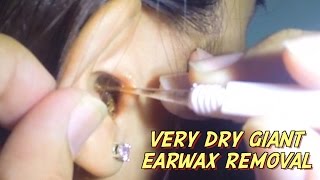 Very Dry Giant Earwax Removal [upl. by Yousuf]