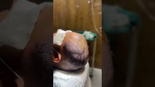 Hair Transplant Aapke Baalon Ka Best Solution 💇‍♂️✨ haircut hairtransplantsolutions [upl. by Jez207]