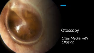 Otitis Media with Effusion Otoscopy [upl. by Anileva]