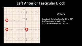 How to Read an ECG Fascicular blocks LAFB LPFB RBBB and LAFB RBBB and LPFB [upl. by Etnahs]