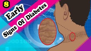 Dont Ignore These Early Symptoms of Diabetes [upl. by Oicirbaf303]