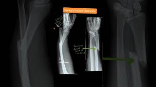 Galeazzi fracture dislocation [upl. by Hopkins352]