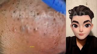 how to remove blackheads from face with tool blackheads satisfying [upl. by Acassej757]