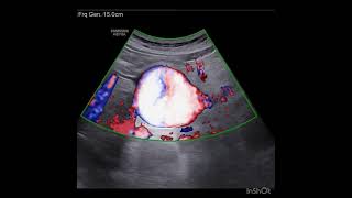 SPLENIC ARTERY PSEUDOANEURYSM [upl. by Adnolehs]