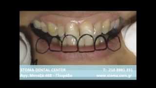 Direct Veneers  Οψεις Ρητινης [upl. by Eissim]