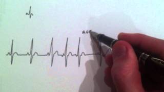 A Cardiologist explains Atrial Ectopic beats with an ECG annotation [upl. by Birk]