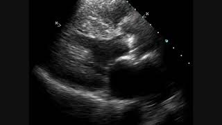 Calcific Aortic Stenosis  Echocardiogram [upl. by Adora]