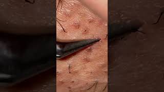 Beard Removal Part 2 satisfying asmr beard waxing beautiful facial blackheads [upl. by Annhoj705]