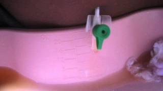 Drainage of Ascites using abdominal paracentesis [upl. by Cerys371]