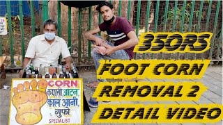 Foot corn removal complete detail videostep by step PART 2  Byculla Mumbai [upl. by Frodin30]