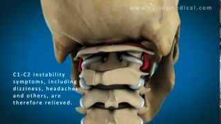 C1 and C2 Atlantoaxial Instability Upper Cervical Instability and Prolotherapy animation [upl. by Jari]