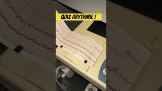 Quiz ECG  retrouvez cette arythmie [upl. by Kcirtapnaes]