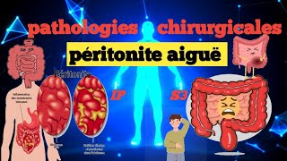 cours S3  Pathologies Chirurgicales et SI  Péritonite aigue 💊🩺💉🩸 شرح سهل 📚و 📚 مبسط للفهم [upl. by Grewitz]