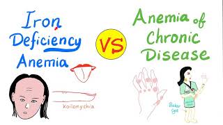 Iron Deficiency Anemia IDA VS Anemia of chronic disease ACD [upl. by Abbe134]