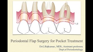 Periodontal flap surgery for pocket treatment part I [upl. by Soelch485]