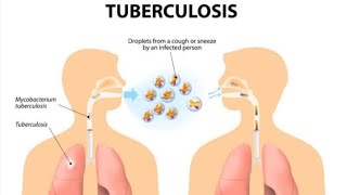 Tuberculosis symptomsdiagnosis treatment and pathogenesis [upl. by Ynohtnaed]