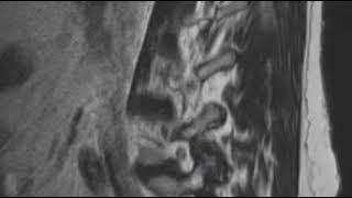 How to Read an MRI Scan of the Lumbar Spine  Lower Back Part 2  First Look MRI [upl. by Gnilyarg]