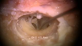 FULL HD  Hands on cadaver Temporal bone dissection Part 1 [upl. by Rosalind]