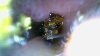 Look What this Ear Wax Removal Camera Found in My Ear [upl. by Nylikcaj]