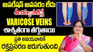 Dr Poorna Rajeshwari  How to Reduce Varicose Veins Without Surgery  Nerve Swelling  iDream [upl. by Yatzeck935]