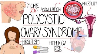 Polycystic Ovary Syndrome Made Easy PCOS Explained [upl. by Enos404]