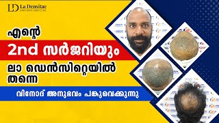 Best hair Transplant Before and After Result  Crown Area  second session  La densitae Kerala [upl. by Wojak]