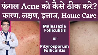 Fungal Acne Treatment In Hindi  फ़ंगल ऐक्नी का इलाज  Malassezia or Pityrosporum Folliculitis [upl. by Essile]