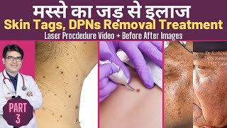 Skin Tags Removal Treatment  DPN Removal Treatment  मस्सो का इलाज  CO2 Laser treatment [upl. by Haelat]