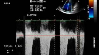 Perimembranous ventricular Septal Defect with Severe Tricuspid Regurgitation [upl. by Lexine]