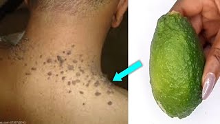 HOW I USE LEMON TO REMOVE SKIN TAG AND MOLE INSTANTLY [upl. by Lennie701]