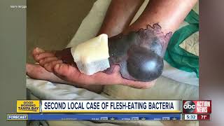 Ohio man contracts flesheating bacteria in Tampa Bay [upl. by Rramed]