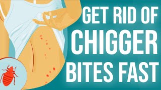 How To Get Rid of Chigger Bites in 2024 [upl. by Swihart]