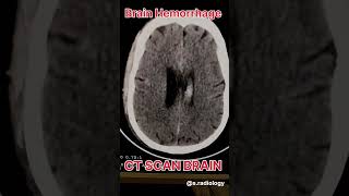 Brain Hemorrhage ct scan radiological [upl. by Salli]