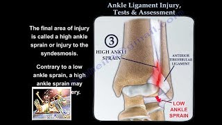 Ankle Ligament Injury evaluation and tests  Everything You Need To Know  Dr Nabil Ebraheim [upl. by Huldah690]