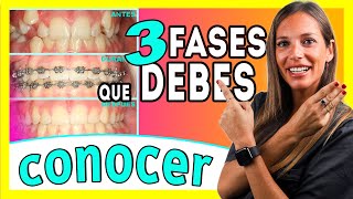 Brackets proceso 𝗠𝗘𝗦 𝗮 𝗠𝗘𝗦 📆 Las ③ 𝐄𝐓𝐀𝐏𝐀𝐒 del TRATAMIENTO de Ortodoncia  Te lo explico ✅ＦÁＣＩＬ [upl. by Theresita]