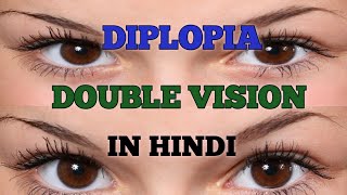 Double Vision  Diplopia In Hindi [upl. by Labotsirhc]