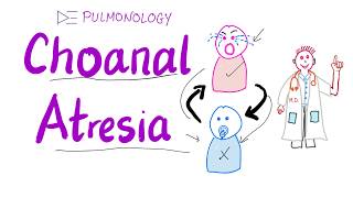 Choanal Atresia  Pink on crying blue on breastfeeding 🤱 ENT amp Pulmonology [upl. by Velvet]