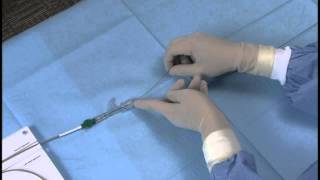 Angioplasty technique pulling out a balloon catheter [upl. by Lesko]