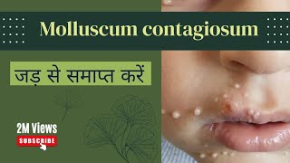 Molluscum contagiosum amp Homeopathy treatment जड़ से ईलाज [upl. by Karmen]