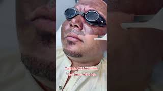 Carbon Laser ￼Facial getsmarthairclub skintreatment shorts shortvideo shortsfeed [upl. by Autum350]