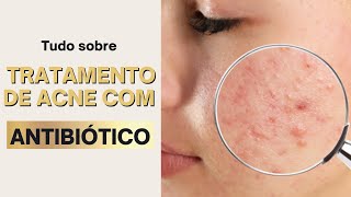 Tudo sobre tratamento de acne com antibiótico [upl. by Balliett]