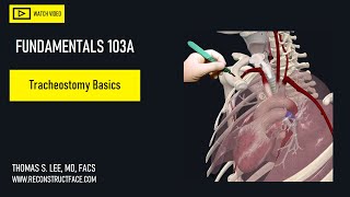 Tracheostomy Basics  ENT perspective  Avoid common complications 103A Didactic [upl. by Coryden]