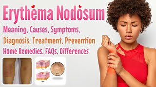 Erythema Nodosum meaning causes symptoms diagnosis treatment prevention home remedies FAQs [upl. by Ocsic745]