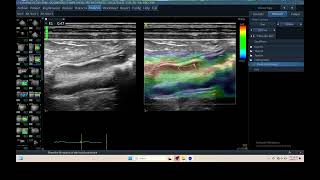 IQ 305 GI TRACK ULTRASOUND ECHOPAC ANALYSIS HEPATOMA ELASTOGRAPHY [upl. by Oram]