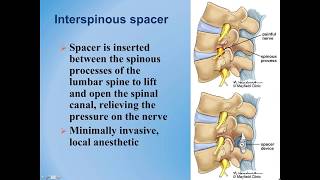 Lumbar Spinal Stenosis  Diagnosis and Treatment Options [upl. by Roscoe903]