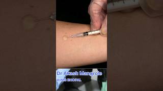 Mantoux Test  Tuberculin Skin Test doctor aiims neet academic mbbsmotivation [upl. by Gilleod309]